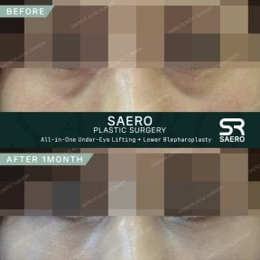 Результати до і після нижньої блефаропластики та підтяжки в SAERO Plastic Surgery