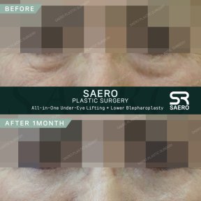 Результати до і після нижньої блефаропластики та підтяжки в SAERO Plastic Surgery