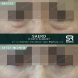 Результати до і після нижньої блефаропластики та підтяжки в SAERO Plastic Surgery