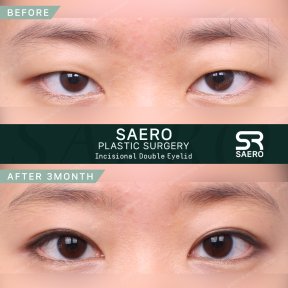Результати до і після інцизійної блефаропластики в клініці SAERO Plastic Surgery