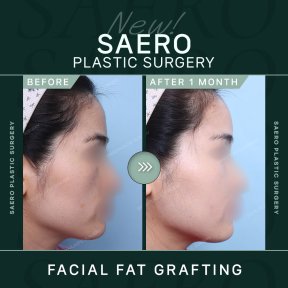 Результати ліпофілінгу обличчя до і після в SAERO Plastic Surgery, покращений контур