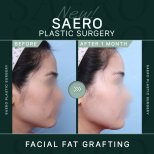 Результати ліпофілінгу обличчя до і після в SAERO Plastic Surgery, покращений контур