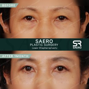Результати нижньої блефаропластики до і після у SAERO Plastic Surgery, 1 місяць після
