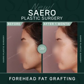 Результати ліпофілінгу чола до і після в SAERO Plastic Surgery, 1 місяць після операції