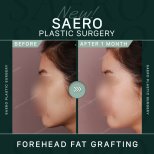 Результати ліпофілінгу чола до і після в SAERO Plastic Surgery, 1 місяць після операції