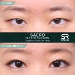 Результати до і після інцизійної блефаропластики в клініці SAERO Plastic Surgery
