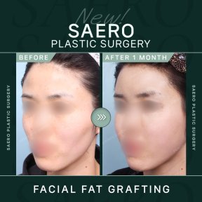 До та після ліпофілінгу обличчя в SAERO Plastic Surgery, повніші щоки через місяць