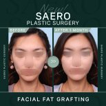 До та після ліпофілінгу обличчя в SAERO Plastic Surgery, помітний результат об'єму