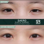 Результати до і після інцизійної блефаропластики в клініці SAERO Plastic Surgery