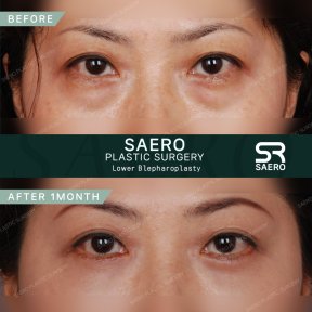 Результати нижньої блефаропластики до і після в SAERO Plastic Surgery, 1 місяць
