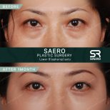 Результати нижньої блефаропластики до і після в SAERO Plastic Surgery, 1 місяць