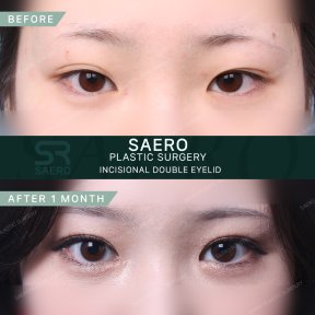 Результати до і після інцизійної блефаропластики в клініці SAERO Plastic Surgery