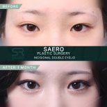 Результати до і після інцизійної блефаропластики в клініці SAERO Plastic Surgery