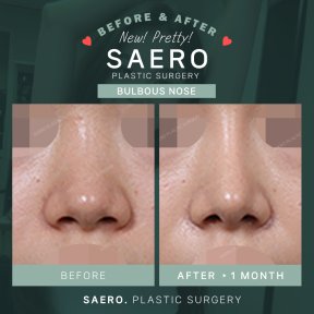 Результати ринопластики кулястого носа до і після в SAERO Plastic Surgery, 1 місяць