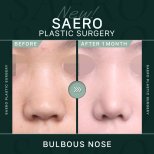 Результати ринопластики кулястого носа в SAERO Plastic Surgery, 1 місяць після операції