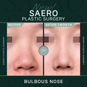 До та після корекції круглого носа в SAERO Plastic Surgery, помітний результат ринопластики
