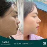 Результати ринопластики без шрамів у SAERO Plastic Surgery, 2 тижні після операції