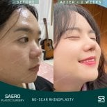 Результати ринопластики без шрамів до і після в SAERO Plastic Surgery, природний контур носа