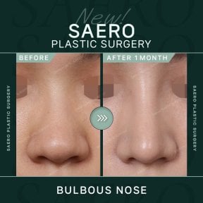 Результат ринопластики кулястого носа до і після в SAERO Plastic Surgery, 1 місяць