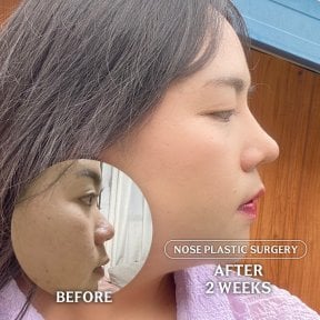 Результати ринопластики до і після в SAERO Plastic Surgery, 2 тижні після операції