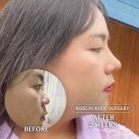 Результати ринопластики до і після в SAERO Plastic Surgery, 2 тижні після операції
