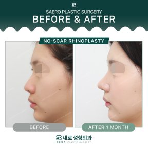 Результати ринопластики без шрамів у SAERO Plastic Surgery, 1 місяць після операції