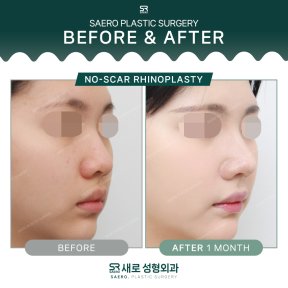 Результати безшрамної ринопластики до і після в SAERO Plastic Surgery, 1 місяць