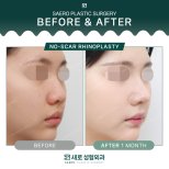 Результати безшрамної ринопластики до і після в SAERO Plastic Surgery, 1 місяць