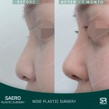 Результати ринопластики до і після в SAERO Plastic Surgery, корекція носа через 1 місяць