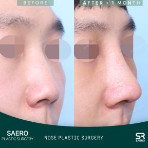 Результати ринопластики до і після в SAERO Plastic Surgery, зміна форми носа через 1 місяць
