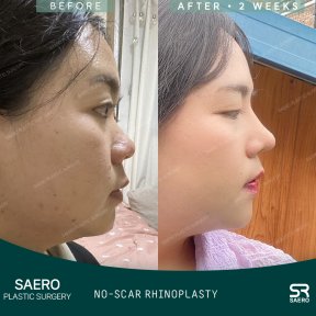 Результати ринопластики без шрамів у SAERO Plastic Surgery, покращений профіль носа