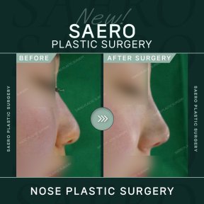 Результати ринопластики до і після в SAERO Plastic Surgery, покращений профіль носа