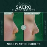 Результати ринопластики до і після в SAERO Plastic Surgery, покращений профіль носа