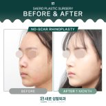 Результати безшрамної ринопластики до і після в SAERO Plastic Surgery, помітна зміна носа