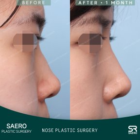 Результати ринопластики до і після в SAERO Plastic Surgery, покращений профіль носа за місяць
