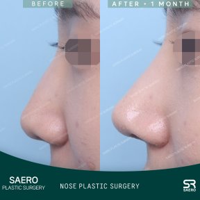 Результати ринопластики до і після в SAERO Plastic Surgery, покращена форма носа за 1 місяць