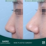 Результати ринопластики до і після в SAERO Plastic Surgery, покращена форма носа за 1 місяць