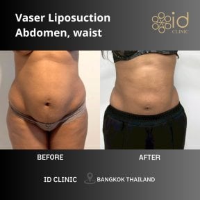 Résultats avant et après liposuccion Vaser abdomen et taille à ID Clinic Bangkok
