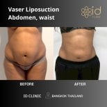 Résultats avant et après liposuccion Vaser abdomen et taille à ID Clinic Bangkok