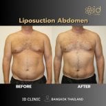 Résultats avant et après liposuccion Vaser abdomen à ID Clinic Bangkok, réduction visible de graisse