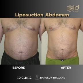 Résultats avant et après liposuccion Vaser abdomen à ID Clinic Bangkok, réduction visible de graisse