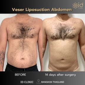 Résultats avant et après liposuccion Vaser abdomen à ID Clinic Bangkok, réduction visible de graisse