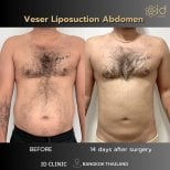 Résultats avant et après liposuccion Vaser abdomen à ID Clinic Bangkok, réduction visible de graisse
