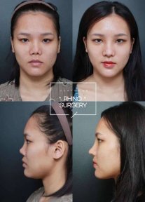 Before and after tip rhinoplasty results at VG Plastic Surgery, improved nose shape and profile
