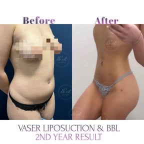 Before and after VASER liposuction and Brazilian Butt Lift results at Db'est Clinic