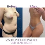 Before and after VASER liposuction and Brazilian Butt Lift results at Db'est Clinic