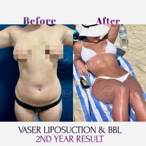 VASER liposuction and Brazilian Butt Lift before and after results at Db'est Clinic