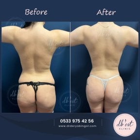 Before and after Brazilian Butt Lift results at Db'est Clinic – enhanced buttock contour