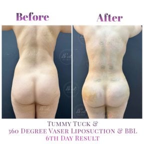 Before and after Brazilian Butt Lift and Vaser liposuction results at Db'est Clinic