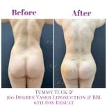 Before and after Brazilian Butt Lift and Vaser liposuction results at Db'est Clinic